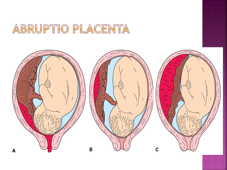 abruptio placentae betekenis